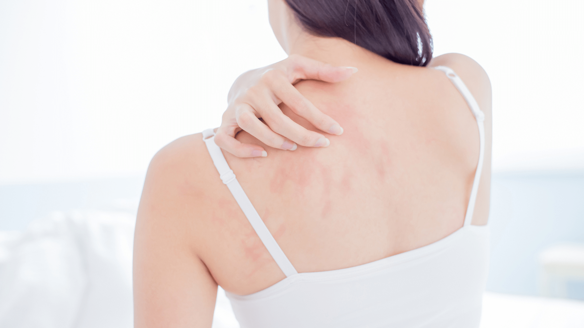 Eczema Fact Sheet