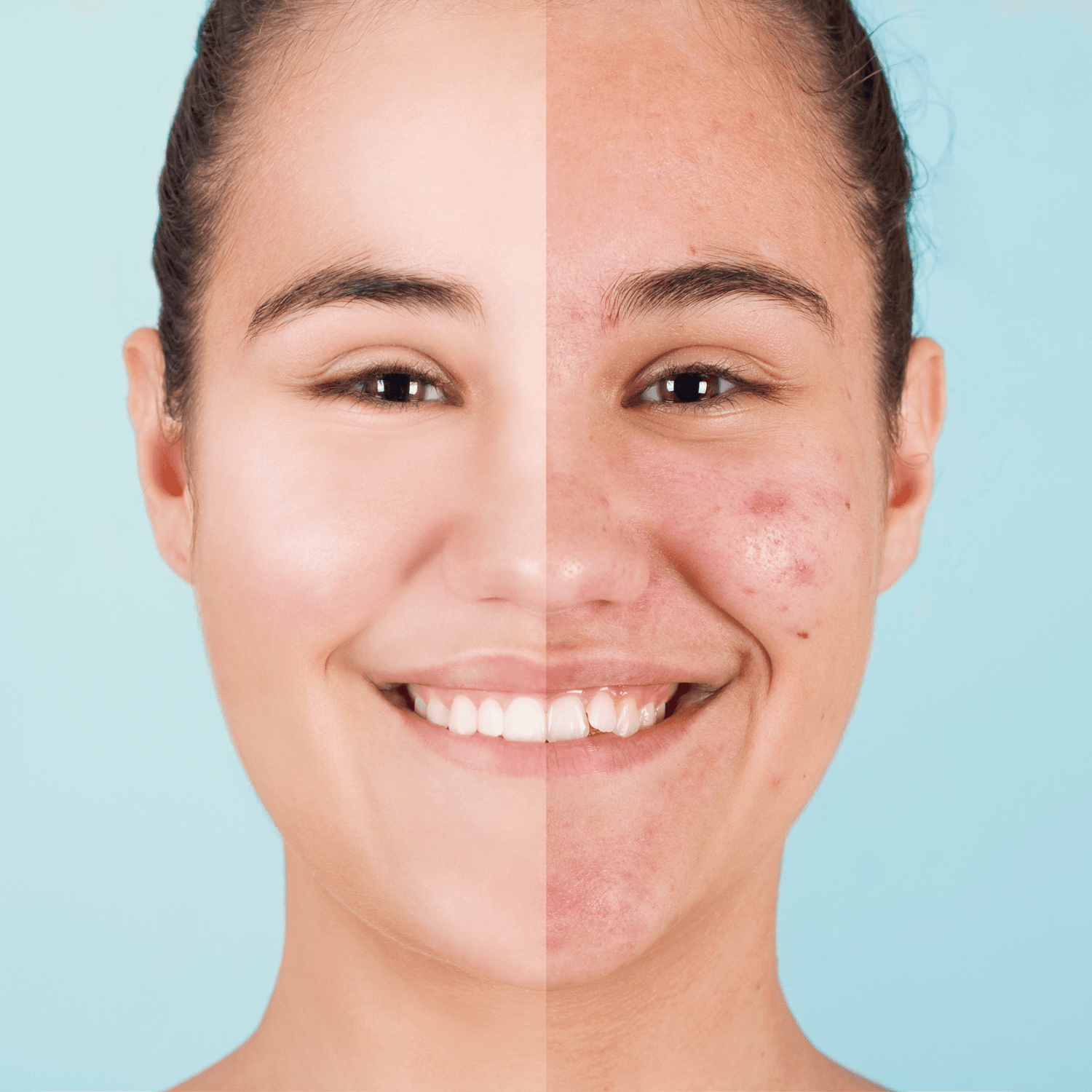 Understanding Acne: Causes, Treatments, and Natural Remedies for Clearer Skin