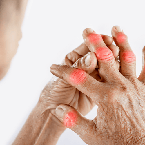 What Is Gout? A complete guide to symptoms, triggers, diets and treatments